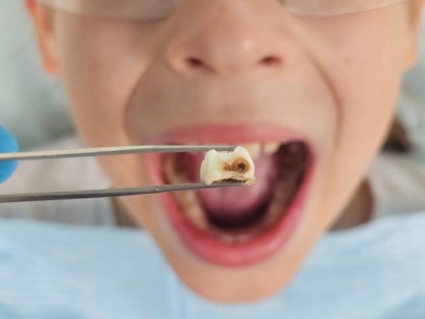 Best Emergency Broken Tooth Repair in New Paleste, IN