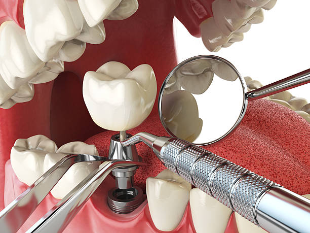 Best Emergency Tooth Extraction in New Paleste, IN